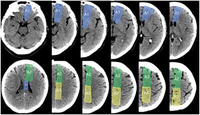 AC-ASPECTS, ACh-ASPECTS, and H-ASPECTS: new imaging scales to assess territorial and total cerebral hemispheric ischemic injury